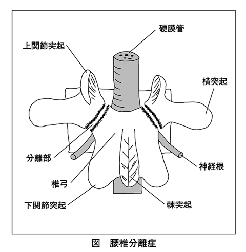 腰椎分離・すべり症(ようついぶんり・すべりしょう)』の意味と定義