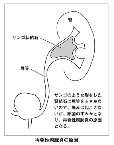 膀胱炎