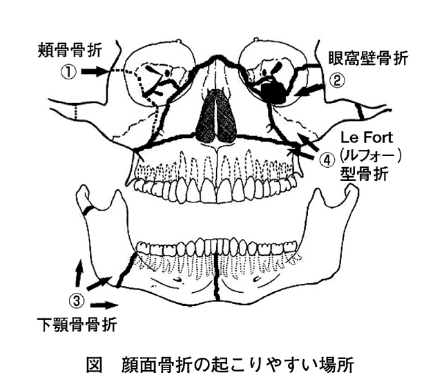 顔面骨折