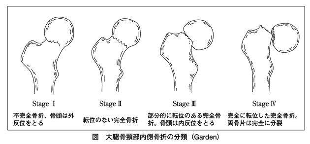 大腿骨頸部骨折