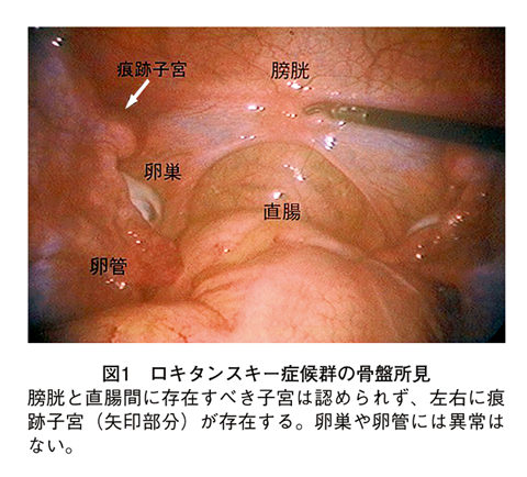子宮発育不全